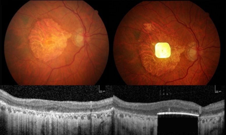 Electronic Eye Implant