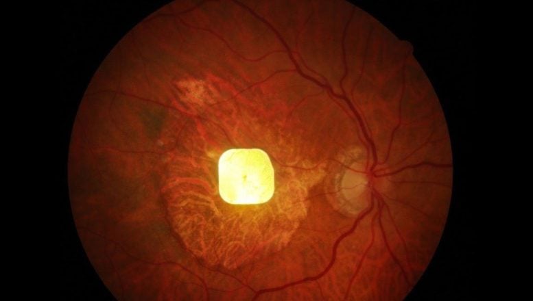 Vision Restoring Eye Implant Device